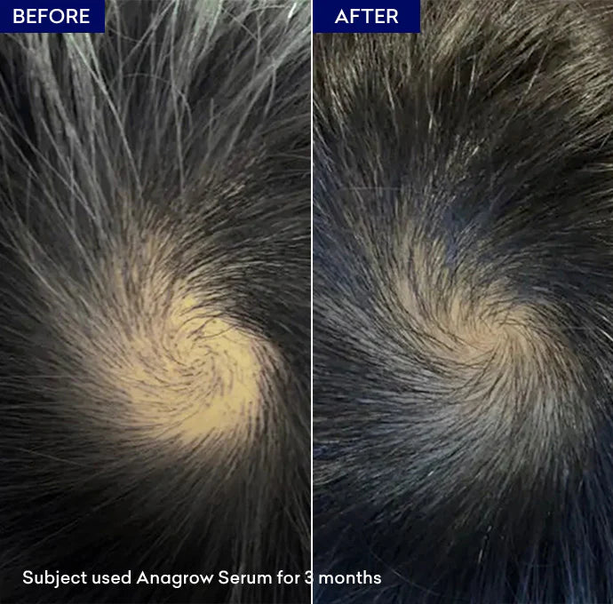 Anagrow Hair Serum Restores Hair | Makes Hair Thicker